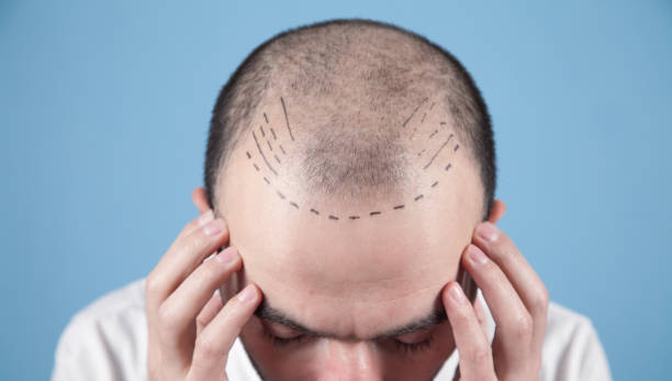 مركز نيرا ماد: الجودة والابتكار في زراعة الشعر
