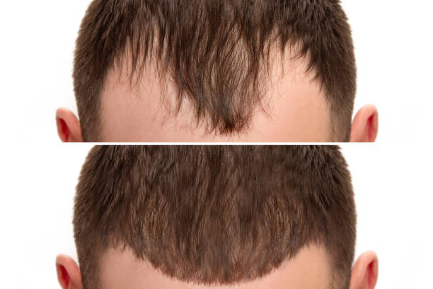 تكلفة زراعة الشعر في مركز نيرا ماد