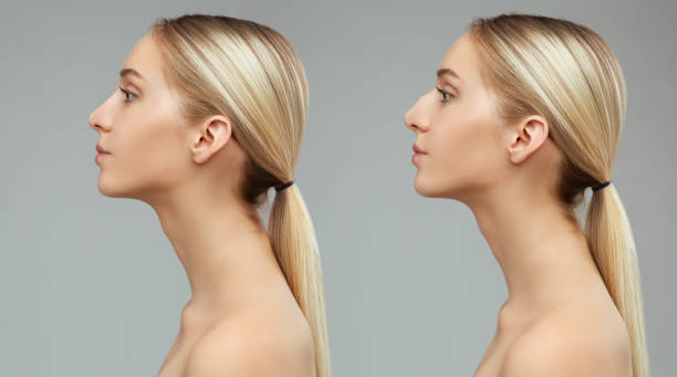 لماذا تعتبر نيرا ماد أفضل عيادة لتجميل الأنف في تركيا؟