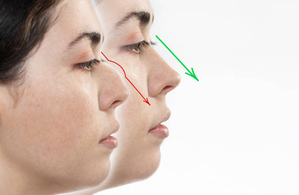 مميزات تجميل الأنف في نيرا ماد