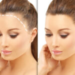 hair transplant