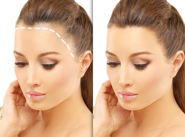 hair transplant