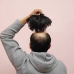 When can you wear a hat after a hair transplant?