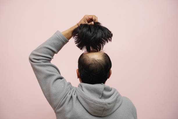 When can you wear a hat after a hair transplant?
