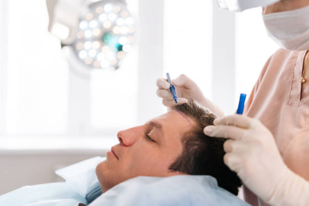 تجارب واقعية لمرضى عانوا من فشل زراعة الشعر
