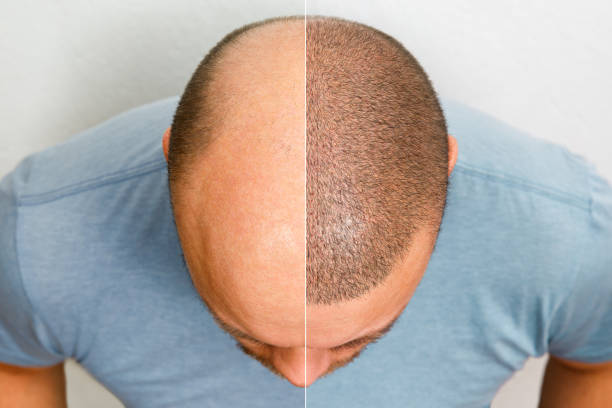 لماذا يعتبر مركز ميد ثار الخيار الأمثل لزراعة الشعر في تركيا؟