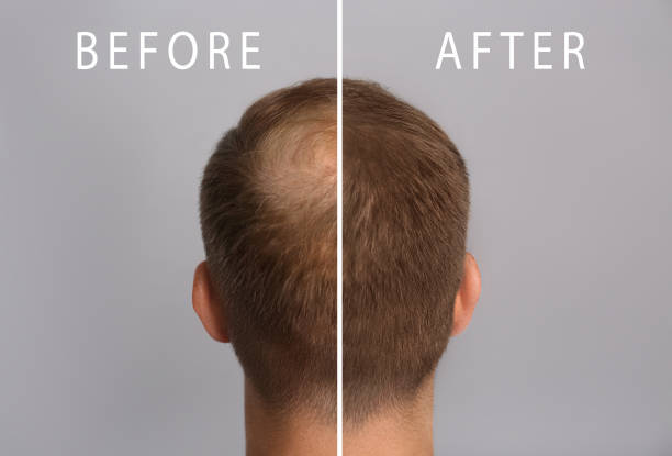 الميزوتيرابي للشعر: آلية العمل والتكلفة مع نيرا ماد